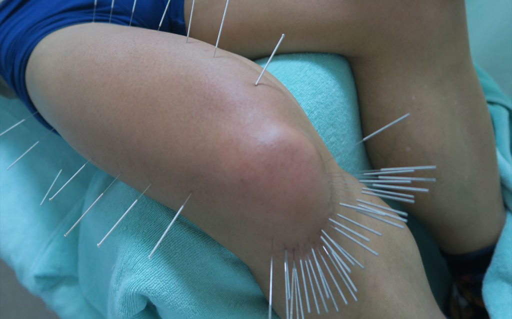 膝関節痛への鍼灸刺鍼の様子